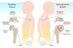 Healthy Bones vs. Osteoporotic Bones - Green Imaging