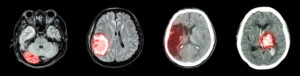 CT Scan - imaging agents or contrast dyes